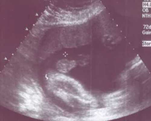 鲜胚移植第四天小肚子抽搐