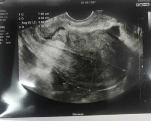 哈尔滨助孕套餐有吗 哈尔滨做试管成功率多少? ‘b超形状看男女’