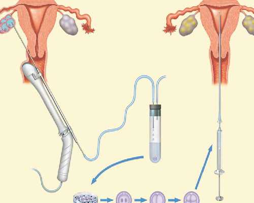 海孕试管供卵供精_供卵可以自己找吗,【北京供卵试管成功率高不高供卵要多少