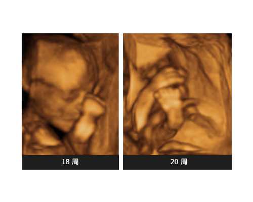 试管婴儿单胎移植和双胎移植哪个更好?试/管婴儿生双胎的几率有多高,代怀男孩