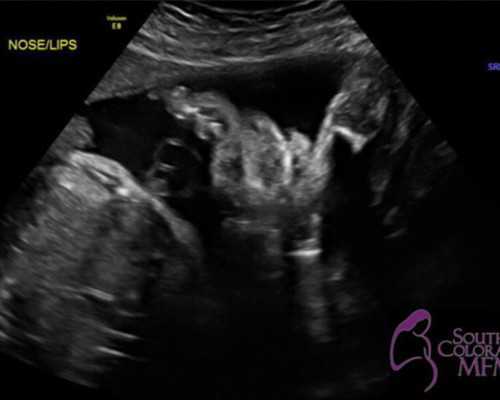 海口单身供卵代怀-福孕供卵机构