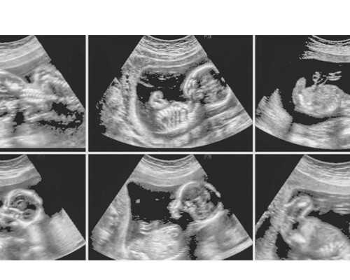 月经前子宫内膜厚度为19mm不进行刮宫手术行吗?,代怀儿子男孩